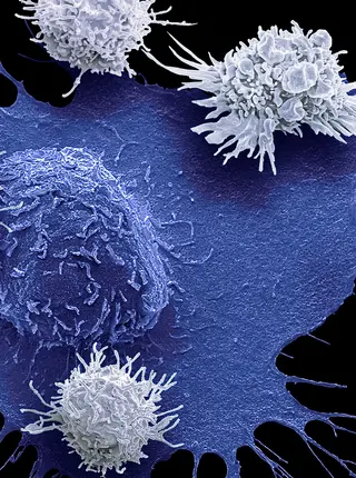 Do Cutting-Edge CAR-T-cell Therapies Cause Cancer? What the Data Say